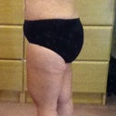 5 weeks post-op (still swollen)