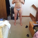10 Days post op front