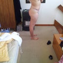 10 days post op side