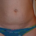 2.5 weeks pre surgery