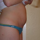 2.5 weeks pre surgery