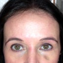 Photo 3 days post filler injection. Sorry, didn't take before photo. Bruising a bit darker, but not phased about it.
