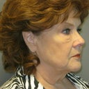 Before right side profile Oct 10, 2011