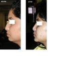 before after profile