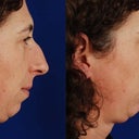 Dr's before and after simluation
