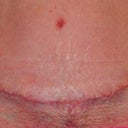 3 1/2 weeks post op, tummy incision