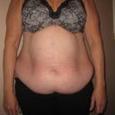 I cannot believe I am posting these pics!!  
pre-op front view