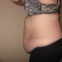 pre-op left side