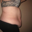 pre-op right side