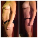 Before and 4 weeks post op.