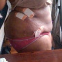 this is day 2 of my surgery i do see a slight difference
