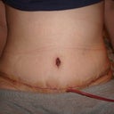 2 days post op