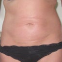June 2010 - 7 months on - can you spot the scars??