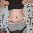 2 wks 2 drains, 2 swollen! Scar is low :)