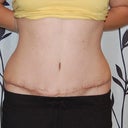 1 month, scar looks GOOD!  Swelling is down, but not gone.  Belly Button is awesome!