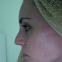2 months post-op