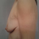 This picture was my before from the Dr's office.