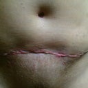 My incision