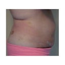 Pre-Op...5 day...13 days