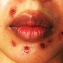 Scabbing