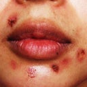 scab flaking