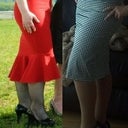 The photo on the left is about 1.5 years before the surgery (in black fishnets) and the picture on the right is 2.5 weeks after the surgery in beige tights.