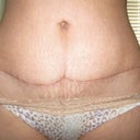 6 weeks post op and 3 weeks using silicone sheets