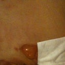 Day 1 Post, I take a peek & surprise!  Mr. Blister grew under my Binder.  I was prepared for skin issues because I have Hyper Atopic Dermatitis & probably more skin issues that I'm not aware of.  I can't wear bandaids, paper tape & all that.