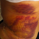 5 Days Post - Part of recovery - You can see the quality work here.