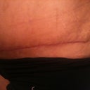 10 Weeks/1 Day Post - The scar is healing well.  I will continue to nourish and massage it.