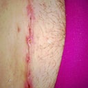 About 3 inches of scar above my moms is getting open areas. I found a stitch sticking out the middle. I am pretty worried!