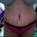 13 days post op
