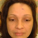 60 Year Old Woman Has Brow Lift