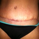 7 weeks 4 days PO
Took pictures this morning, but they look exactly the same as 41 days PO, so decided to post a pic of what my scar looks like now!