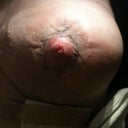 Rt boob day 3