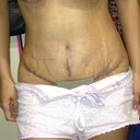 Day: 14 before taking my shower I wanted to take some pics for u guys . Everything is healing good, except stitches by my crotch are wanting to open a little so he told me to wear an absorbent gauze on it . Belly button looks like it's infected , but doctor says that it's normal for it to  look like that.