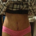 Very happy that my underwear will cover scar naturally as well :) also i can finally see some thigh gap! never had that before , however doctor says that i will see the  final results in about 4-6 months on lipo.