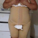 Front view of my sister that had lipo n butt fat transfer