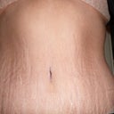 After 2.5 weeks..Love my new belly button.  I have never liked mine.  I was teased relentlessly as a child because I had an outie.  And....I have a waist!! Woo Hoo!  I will always have stretch marks but I don't even care at this point!