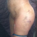 5 days post op
