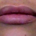 exactly one month after procedure