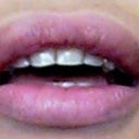 exactly one month after procedure