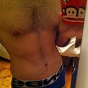 Post Op - 1 Month - Starting to look normal again!
