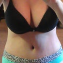 9 days post op - still very hunched over but as you can see, flat tummy and incision is easily covered by panties. I had hernia repair and belly button was completely reconstructed and still have stitches. I get them removed next Monday! (Squeal!)
