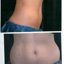 Before from side and front