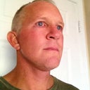 2 weeks after surgery...  scars around my ears are healing pretty good.  Still pretty swollen under my chin, side of face and under eyes (pulling my lower eyelids down a little still).  So far, so good...
