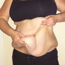 day before I went for my tummy tuck!