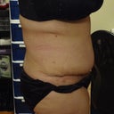 3 months after tummy tuck