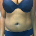 Day of surgery (pre) front pic....I lost 10 lbs