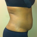 Day of surgery (pre) side pic....I lost 10 lbs